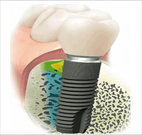 Bio-implant - Parts by Pure Ti Powder